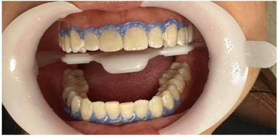 Antes do clareamento dental