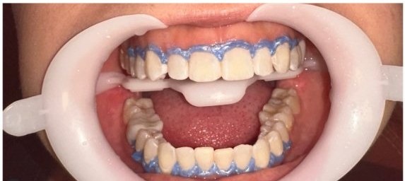 Depois do clareamento dental