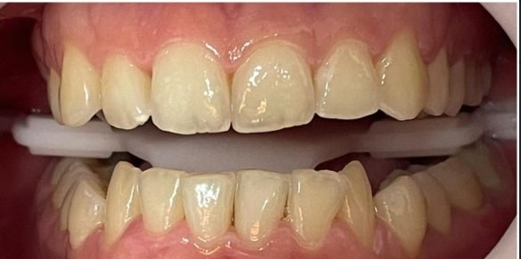 Antes do clareamento