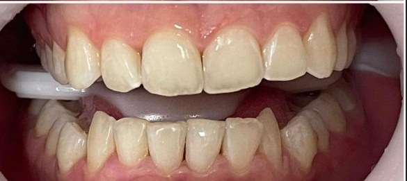 Depois do clareamento