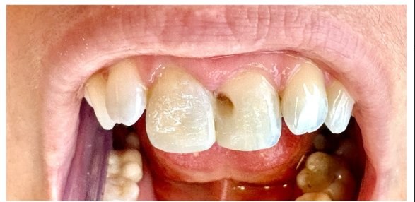 Antes da reconstrução, dente fraturado