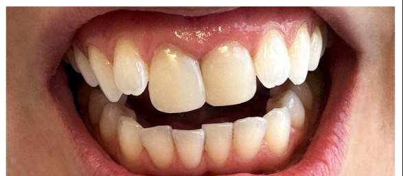 Depois da reconstrução em resina