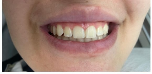 Antes das facetas de resina