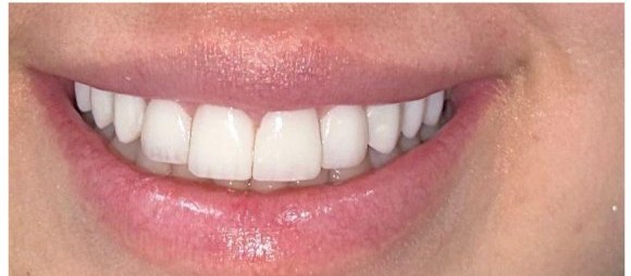 Depois das facetas de resina