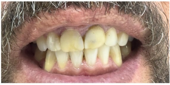 Antes das facetas, escurecimento dental