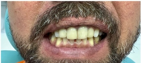 Depois das facetas, sorriso renovado