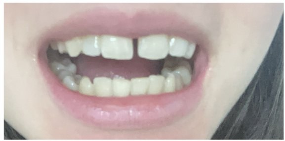 Antes das facetas, com espaço entre os dentes