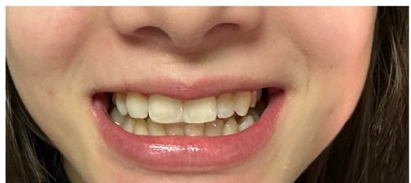 Depois das facetas, espaço fechado