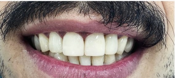 Depois das facetas, sorriso luminoso